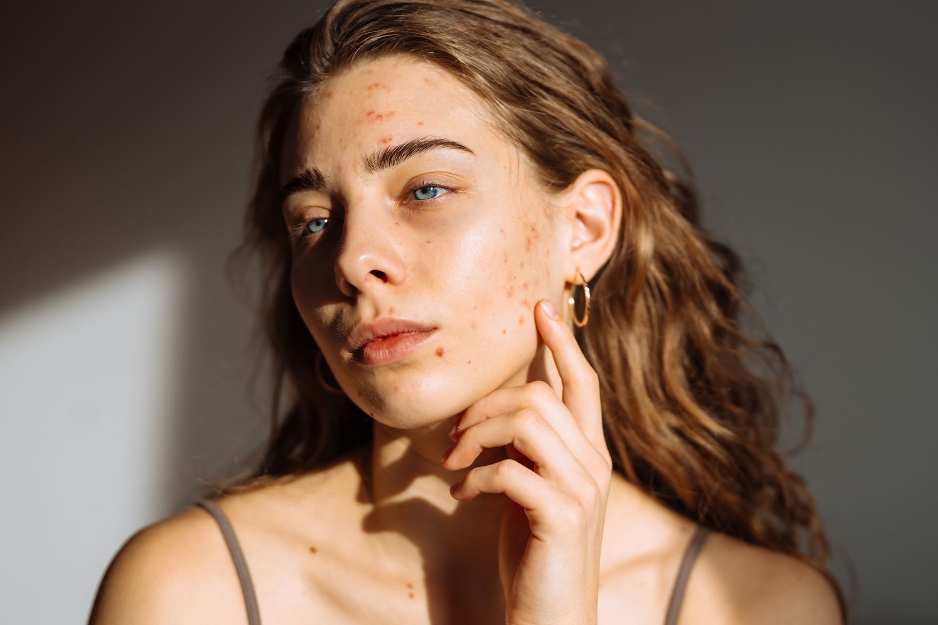 How Our Face Reality Acne Bootcamp Addresses Persistent Acne